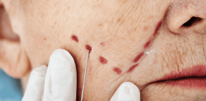 facelifts compensation claim