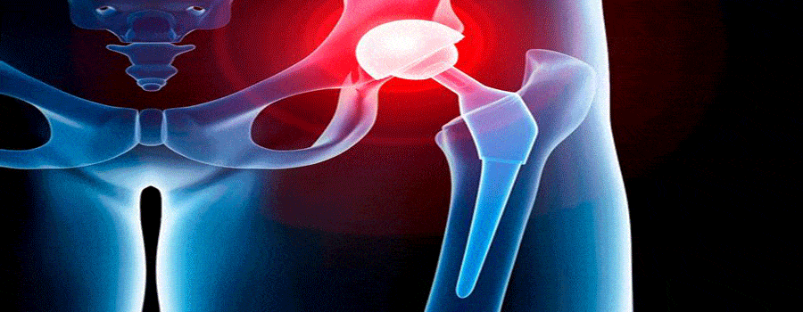 hip replacement picture