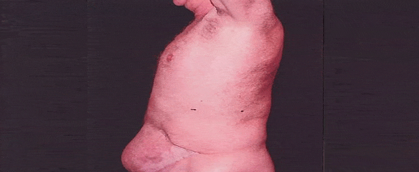 mans swollen stomach after medical negligence